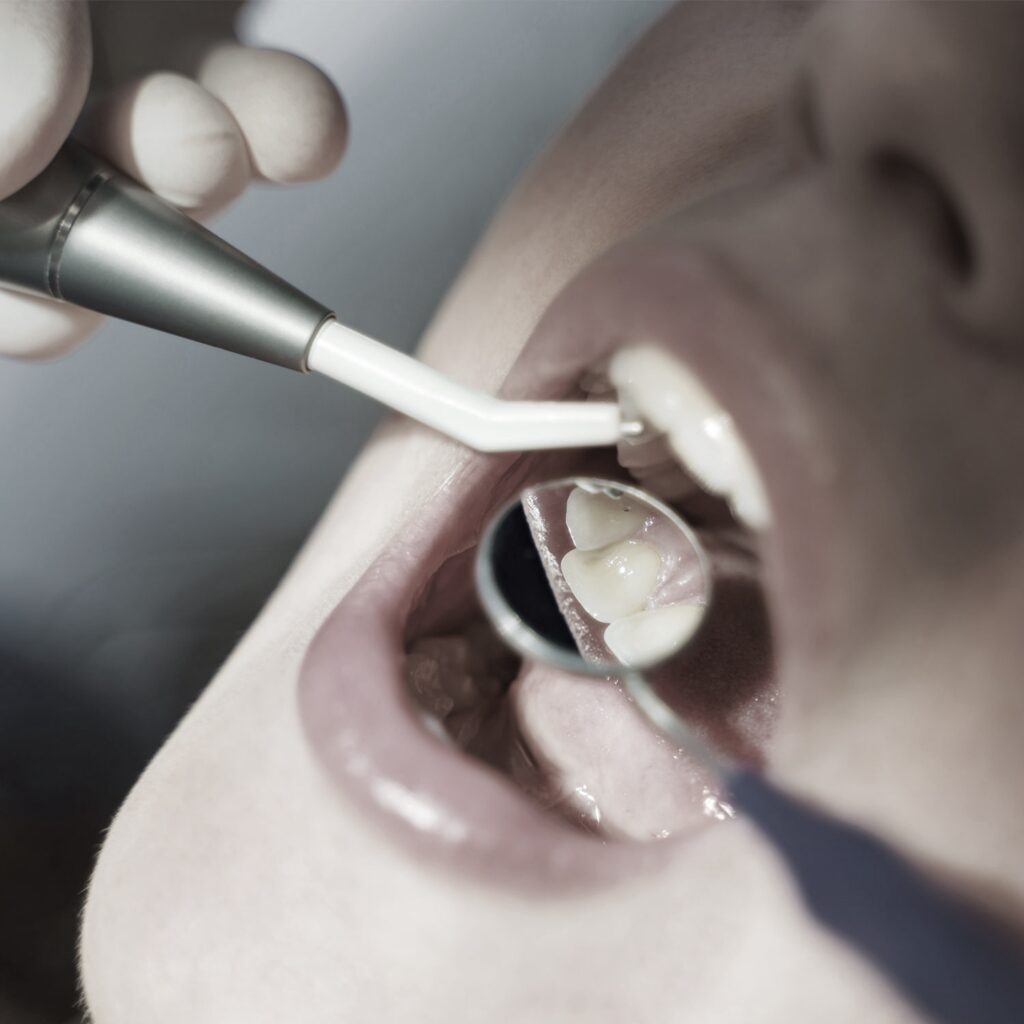 Carie ai Denti