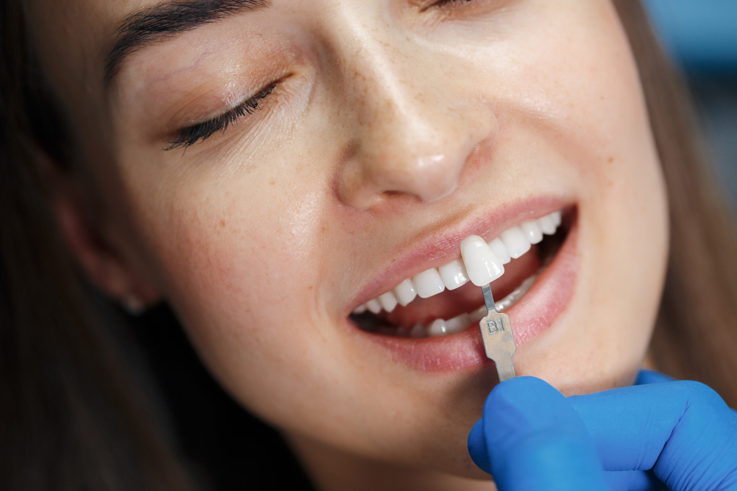 Faccette Dentali