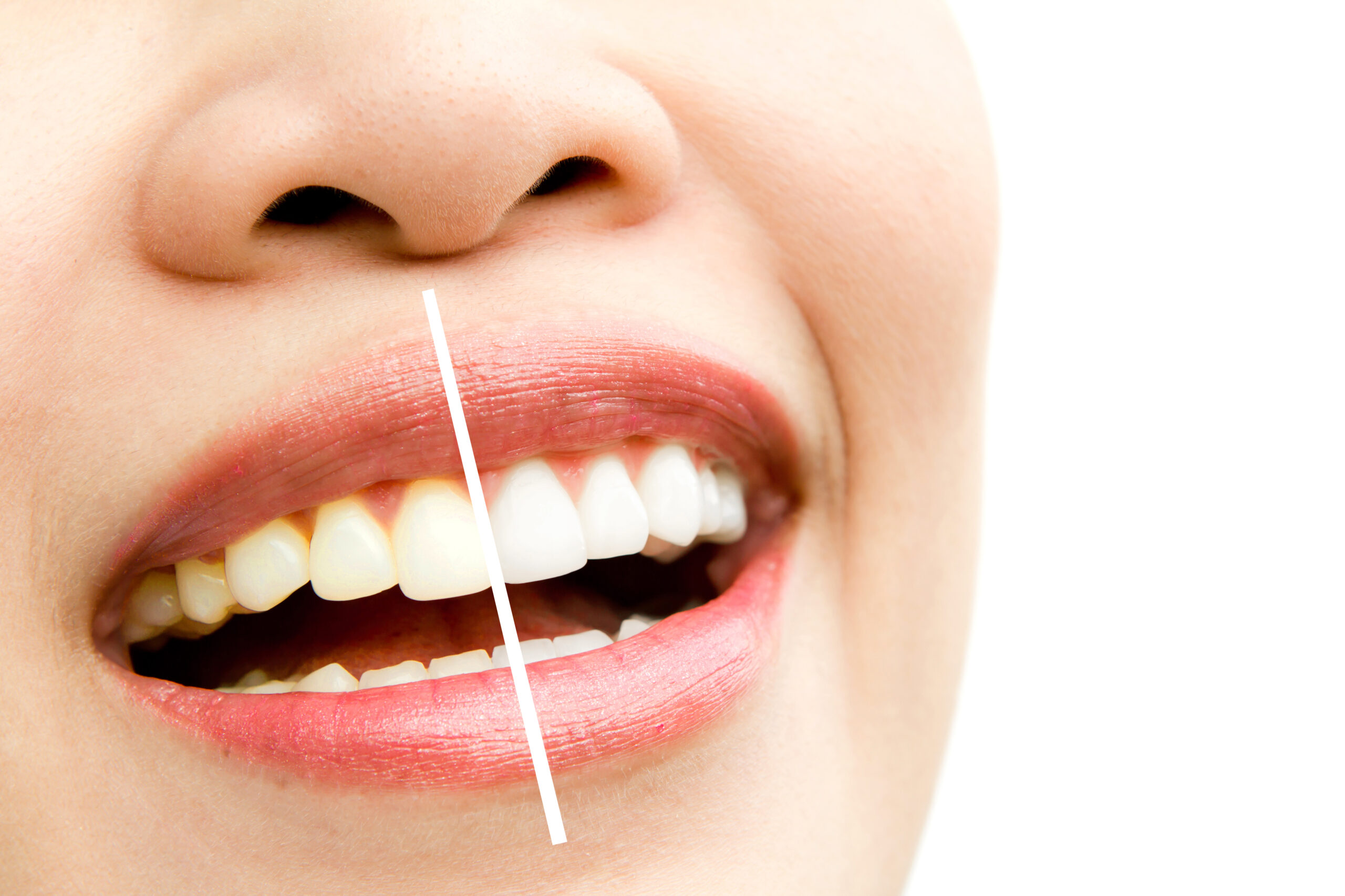 Quanto Costa uno Sbiancamento Dentale