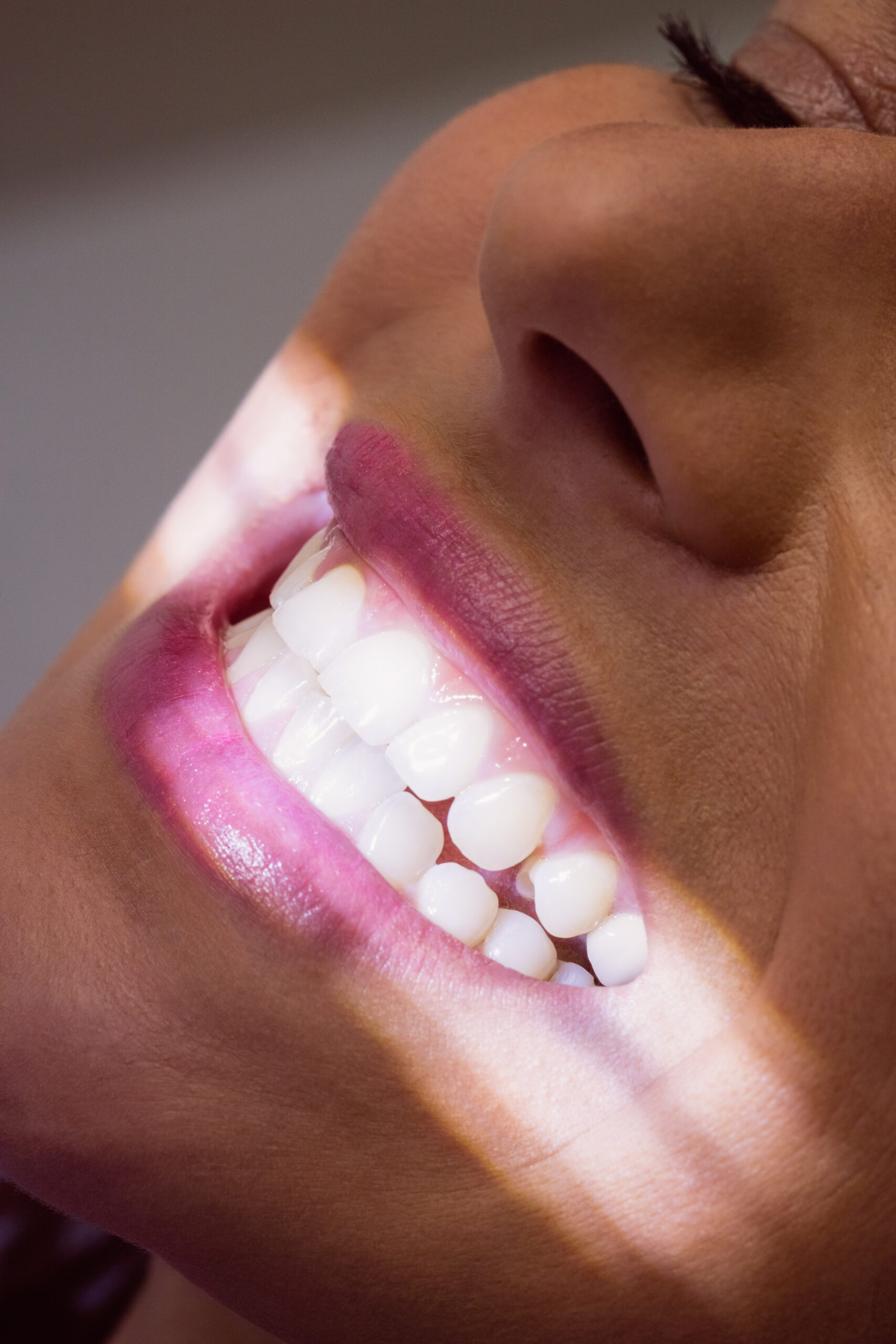 Sbiancamento Dentale